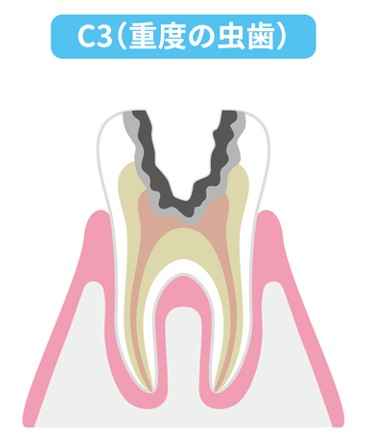 重度の虫歯C3